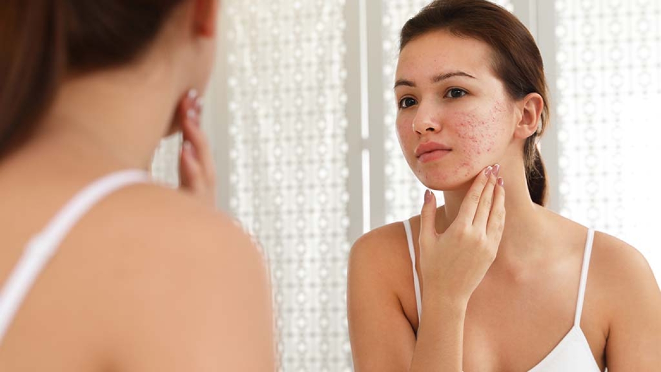 Rimedi cicatrici acne
